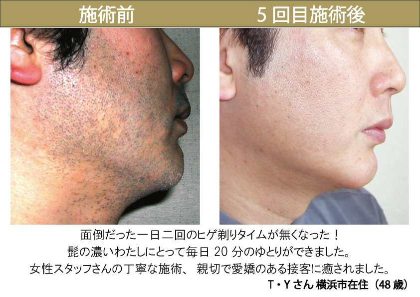 クイックメンズ脱毛 Mr7