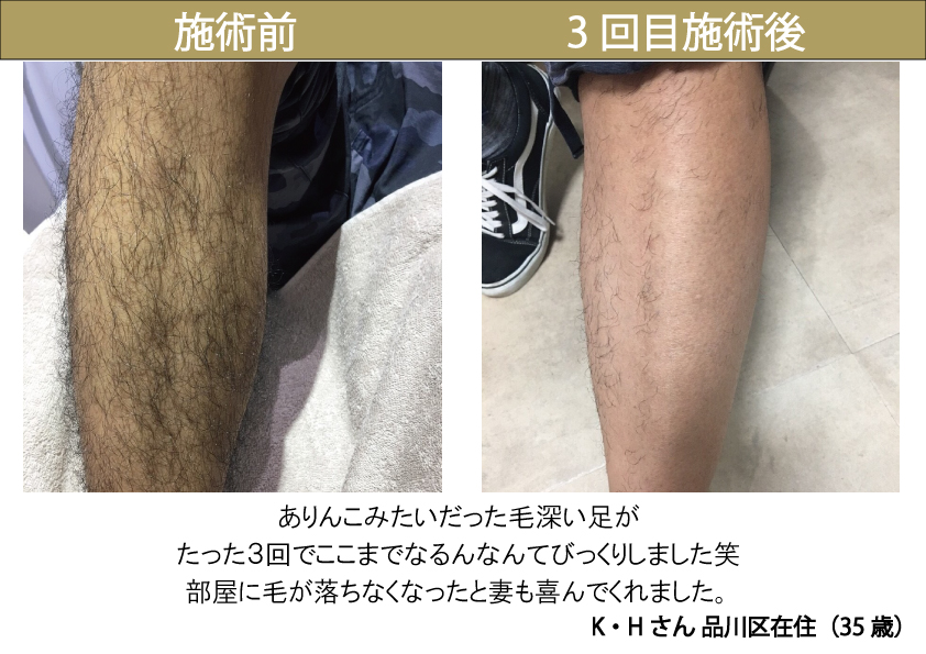 クイックメンズ脱毛 Mr7